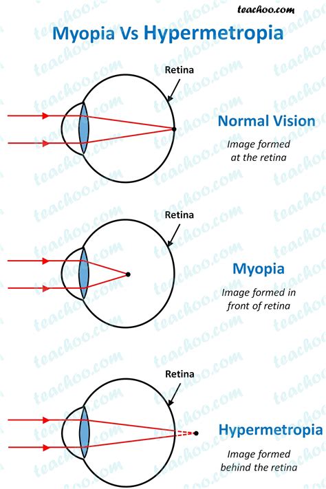 myopia vs hypermetropia.